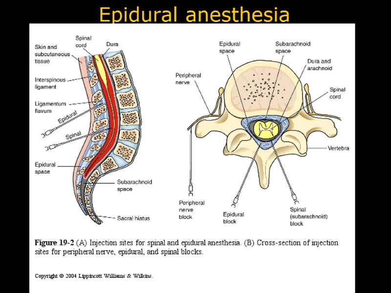 Epidural anesthesia